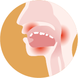 Mondproblemen en slikstoornissen in de palliatieve fase Ontstekingen en infecties